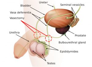 Vasectomy. Image: Wikipedia